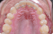Patient 2.  Problem: Narrow arch  Treatment type: Braces, RME, extractions and surgery 