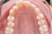 Patient 1.  Problem: Upper & lower crowding  Treatment type: Invisalign® 