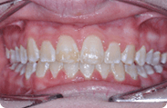 Patient 7.  Problem: Jaw position  Treatment type: Herbst appliance and braces 