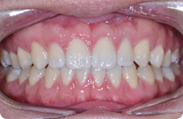 Patient 6.  Problem: Spacing  Treatment type: Invisalign® 