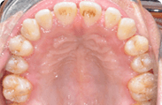 Patient 8.  Problem: Spacing and Jaw position  Treatment type: Braces, premolar extractions & surgery 