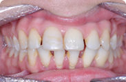 Patient 4.  Problem: Spacing in teeth  Treatment type: Braces 